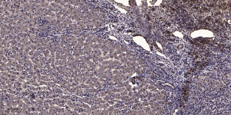 Immunohistochemical analysis of paraffin-embedded human liver cancer. 1, Antibody was diluted at 1:200 (4 ℃ overnight). 2, Tris-EDTA, pH9.0 was used for antigen retrieval. 3,Secondary antibody was diluted at 1:200 (room temperature, 45min).